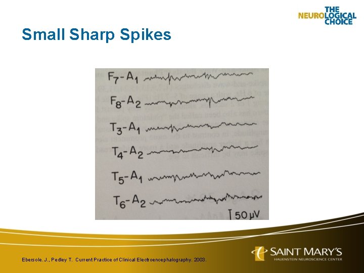 Small Sharp Spikes Ebersole. J. , Pedley T. Current Practice of Clinical Electroencephalography. 2003.