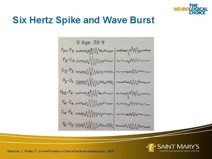 Six Hertz Spike and Wave Burst Ebersole. J. , Pedley T. Current Practice of