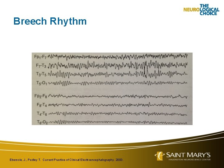 Breech Rhythm Ebersole. J. , Pedley T. Current Practice of Clinical Electroencephalography. 2003. 