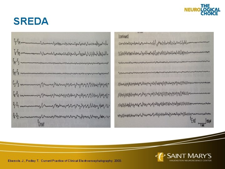 SREDA Ebersole. J. , Pedley T. Current Practice of Clinical Electroencephalography. 2003. 