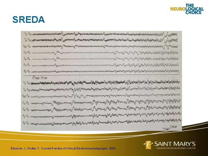 SREDA Ebersole. J. , Pedley T. Current Practice of Clinical Electroencephalography. 2003. 