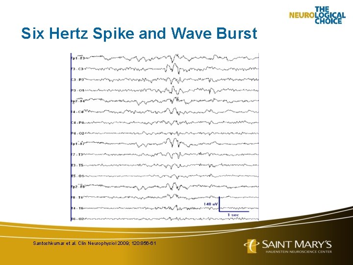 Six Hertz Spike and Wave Burst Santoshkumar et al. Clin Neurophysiol 2009; 120: 856