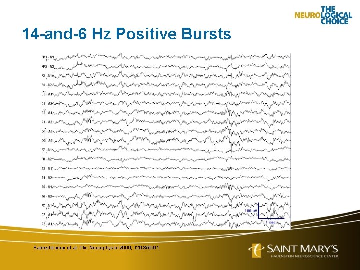 14 -and-6 Hz Positive Bursts Santoshkumar et al. Clin Neurophysiol 2009; 120: 856 -61