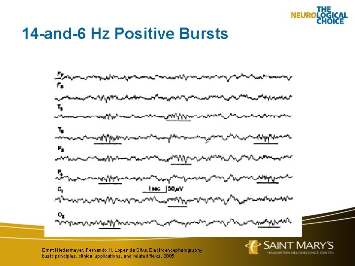 14 -and-6 Hz Positive Bursts Ernst Niedermeyer, Fernando H. Lopes da Silva. Electroencephalography: basic