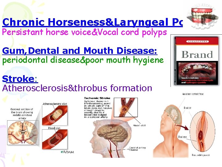 Chronic Horseness&Laryngeal Polyps: Persistant horse voice&Vocal cord polyps Gum, Dental and Mouth Disease: periodontal