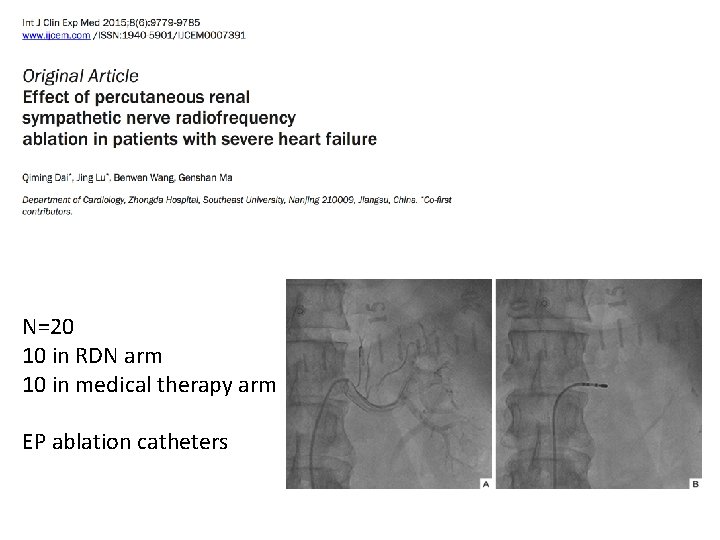 N=20 10 in RDN arm 10 in medical therapy arm EP ablation catheters 