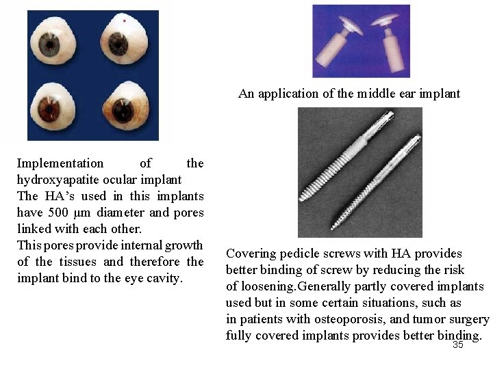 An application of the middle ear implant Implementation of the hydroxyapatite ocular implant The