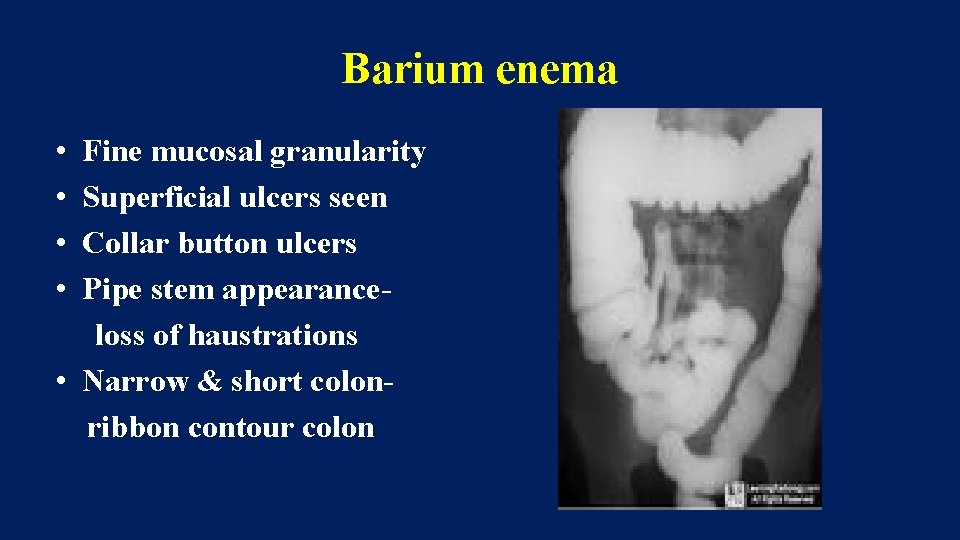 Barium enema • • Fine mucosal granularity Superficial ulcers seen Collar button ulcers Pipe