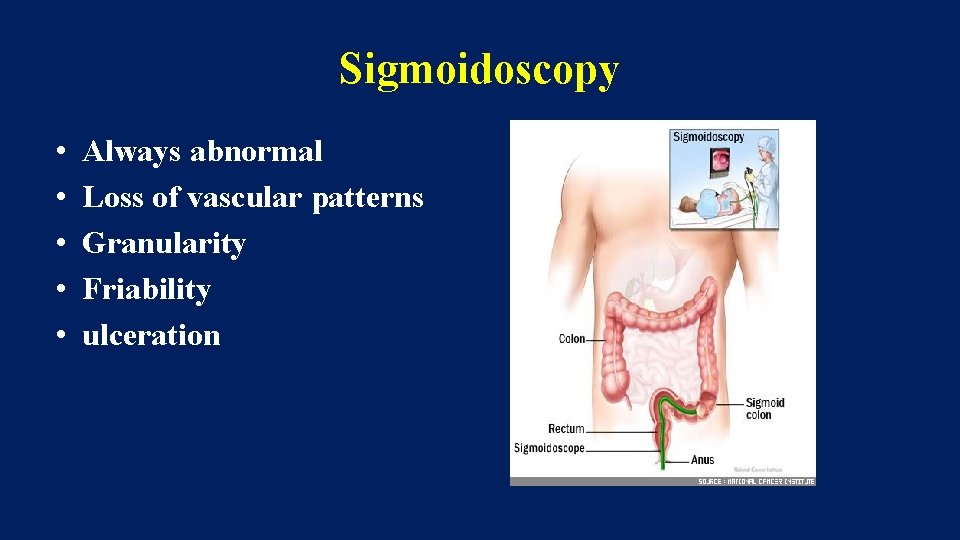 Sigmoidoscopy • • • Always abnormal Loss of vascular patterns Granularity Friability ulceration 