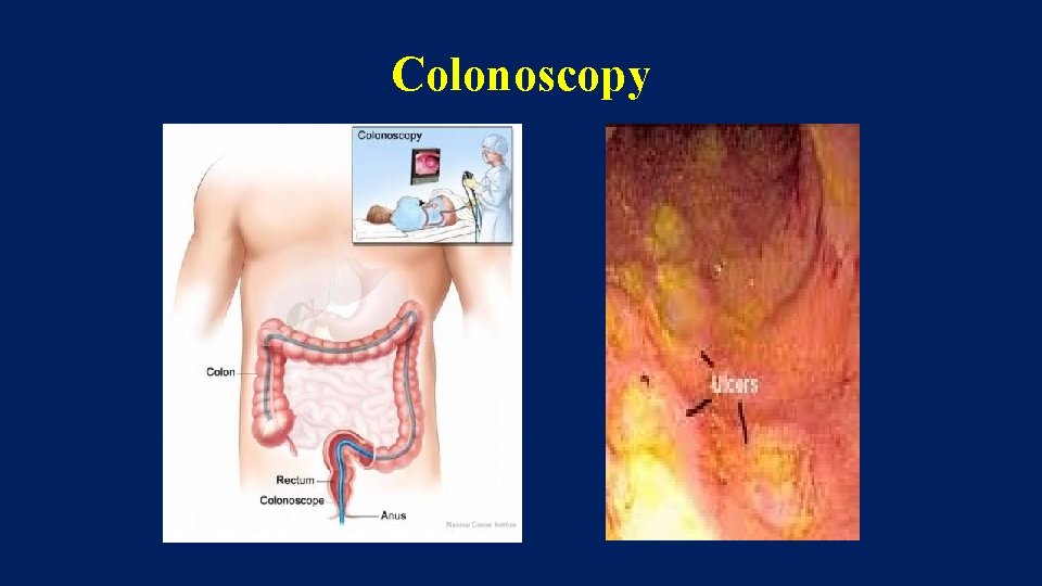 Colonoscopy 