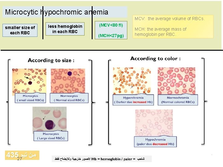 Microcytic hypochromic anemia MCV: the average volume of RBCs. smaller size of each RBC