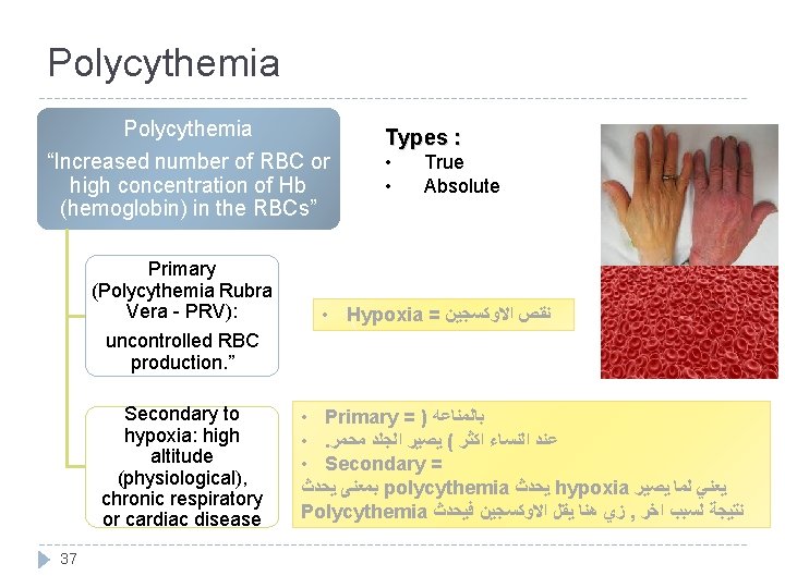 Polycythemia “Increased number of RBC or high concentration of Hb (hemoglobin) in the RBCs”