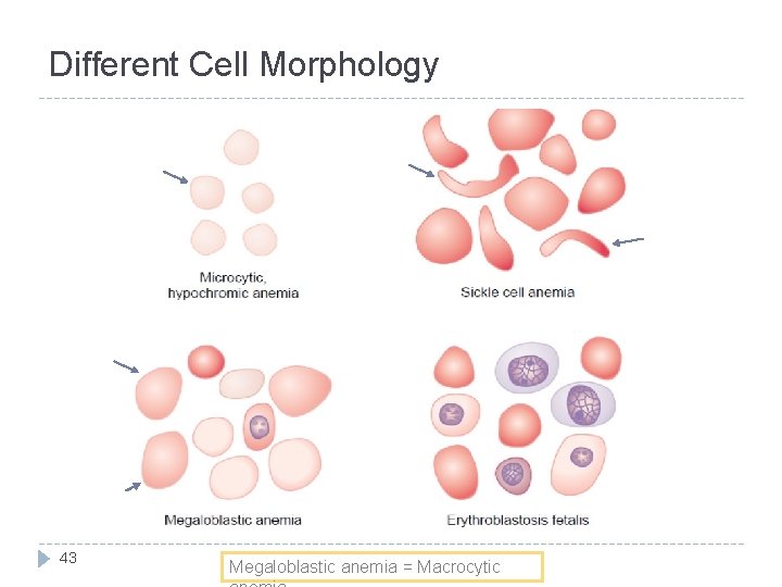 Different Cell Morphology 43 Megaloblastic anemia = Macrocytic 