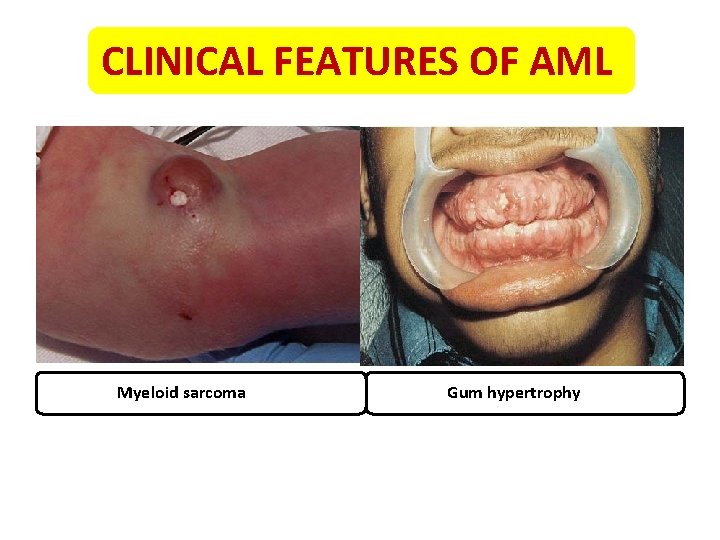 CLINICAL FEATURES OF AML Myeloid sarcoma Gum hypertrophy 