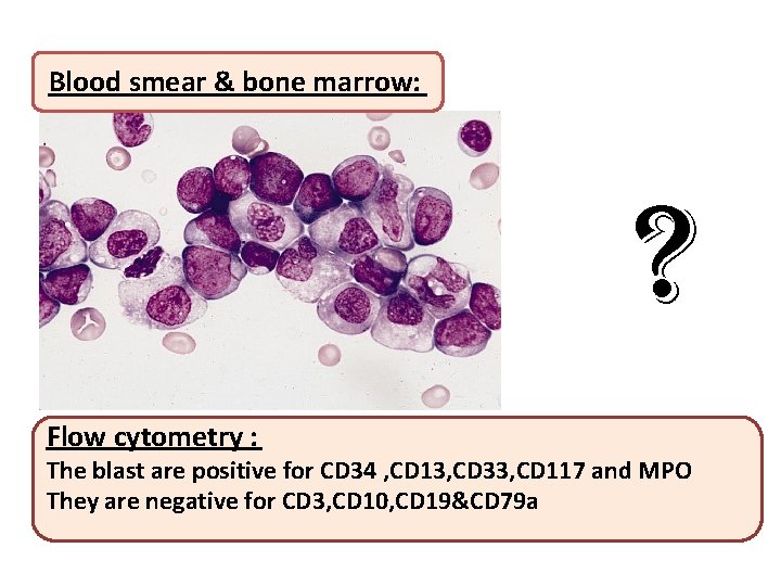 Blood smear & bone marrow: ? Flow cytometry : The blast are positive for