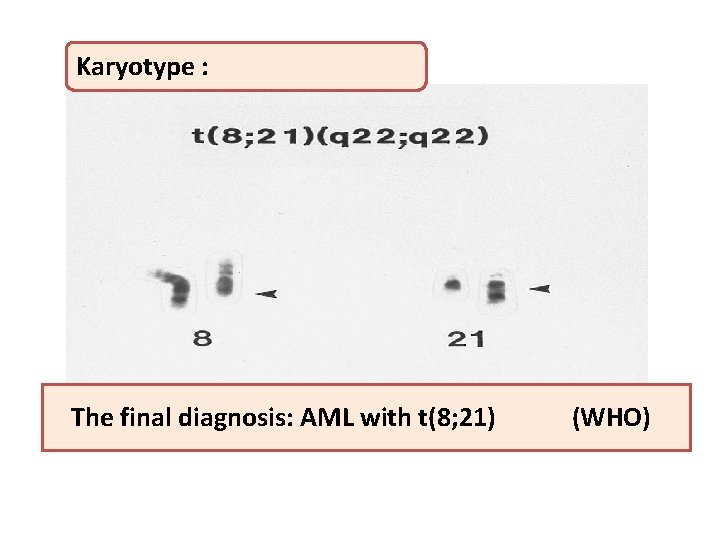 Karyotype : The final diagnosis: AML with t(8; 21) (WHO) 