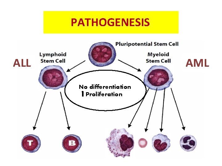 PATHOGENESIS AML ALL No differentiation Proliferation 