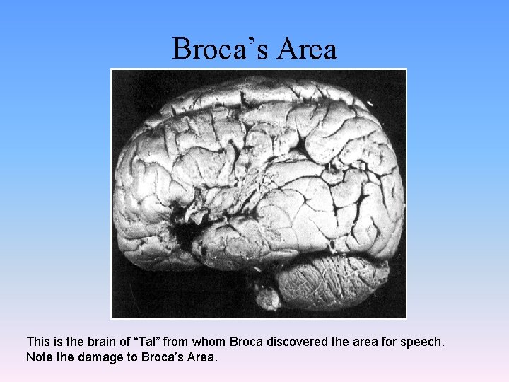 Broca’s Area This is the brain of “Tal” from whom Broca discovered the area