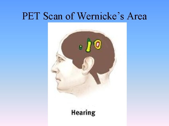 PET Scan of Wernicke’s Area 