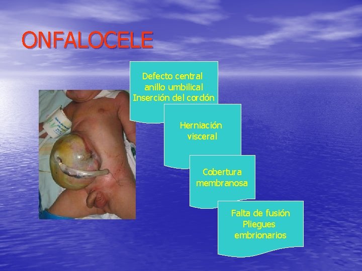 ONFALOCELE Defecto central anillo umbilical Inserción del cordón Herniación visceral Cobertura membranosa Falta de