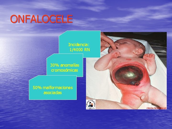 ONFALOCELE Incidencia: 1/4000 RN 30% anomalías cromosómicas 50% malformaciones asociadas 