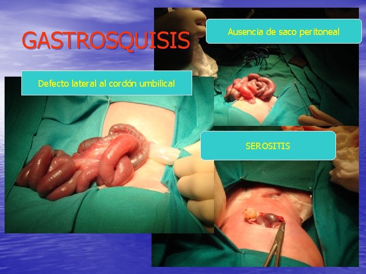 GASTROSQUISIS Ausencia de saco peritoneal Defecto lateral al cordón umbilical SEROSITIS 