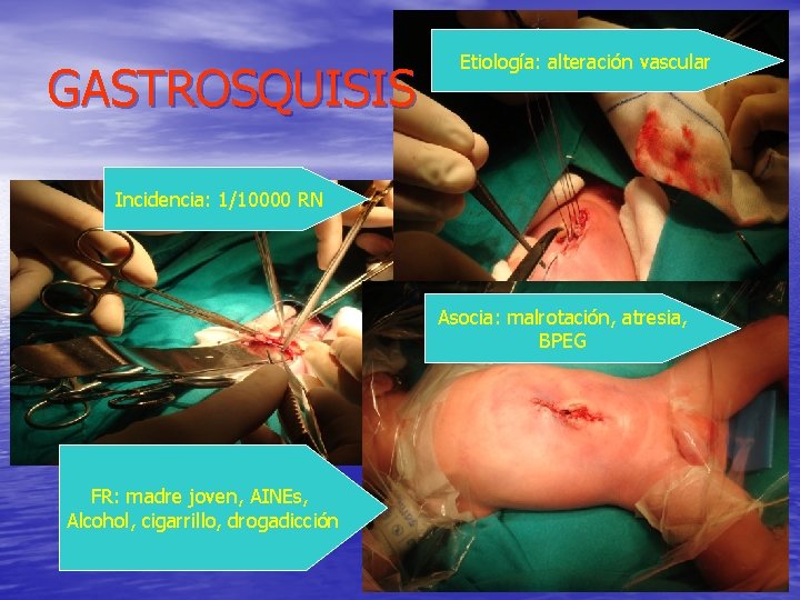 GASTROSQUISIS Etiología: alteración vascular Incidencia: 1/10000 RN Asocia: malrotación, atresia, BPEG FR: madre joven,