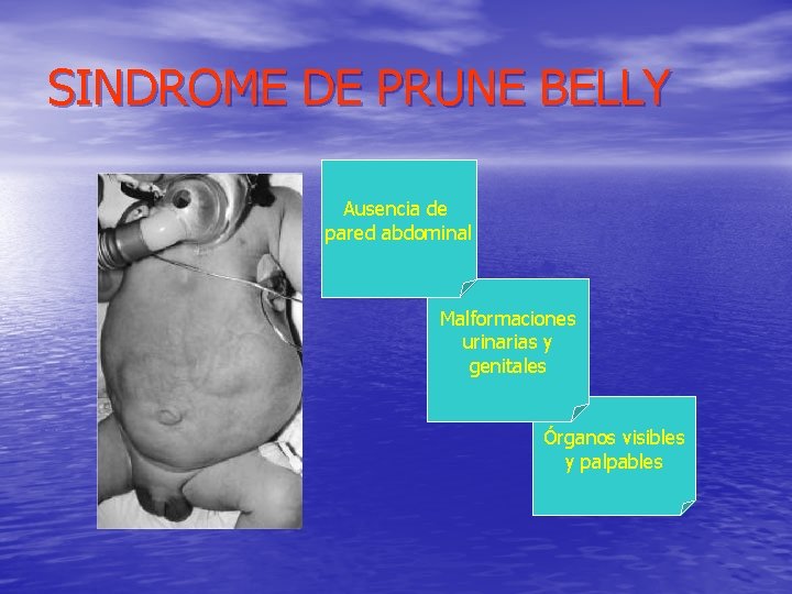 SINDROME DE PRUNE BELLY Ausencia de pared abdominal Malformaciones urinarias y genitales Órganos visibles