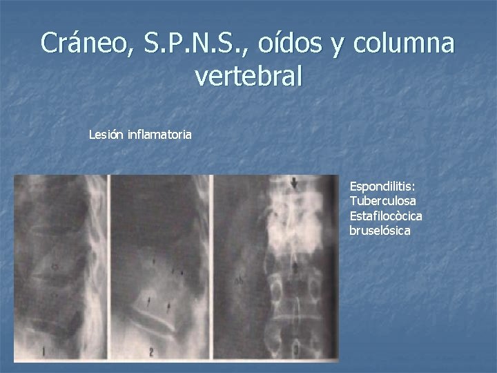 Cráneo, S. P. N. S. , oídos y columna vertebral Lesión inflamatoria Espondilitis: Tuberculosa