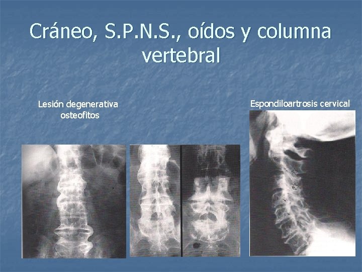 Cráneo, S. P. N. S. , oídos y columna vertebral Lesión degenerativa osteofitos Espondiloartrosis