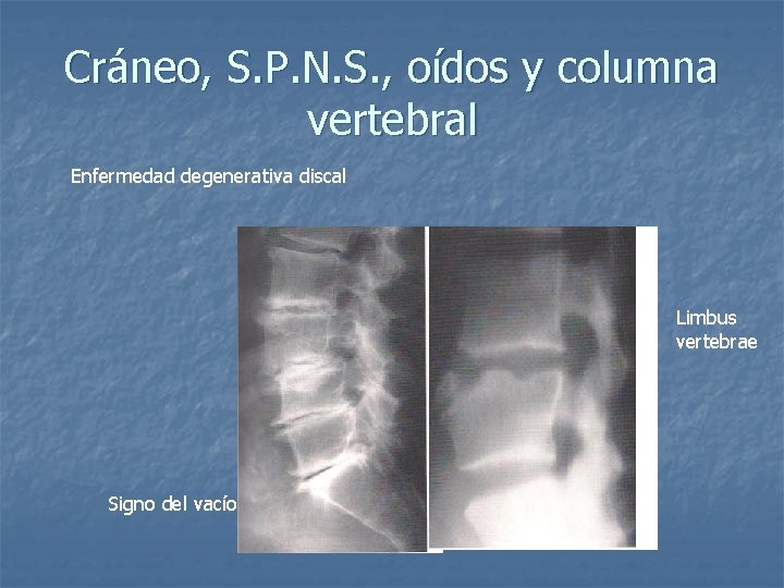 Cráneo, S. P. N. S. , oídos y columna vertebral Enfermedad degenerativa discal Limbus