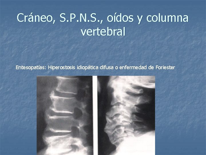 Cráneo, S. P. N. S. , oídos y columna vertebral Entesopatías: Hiperostosis idiopática difusa