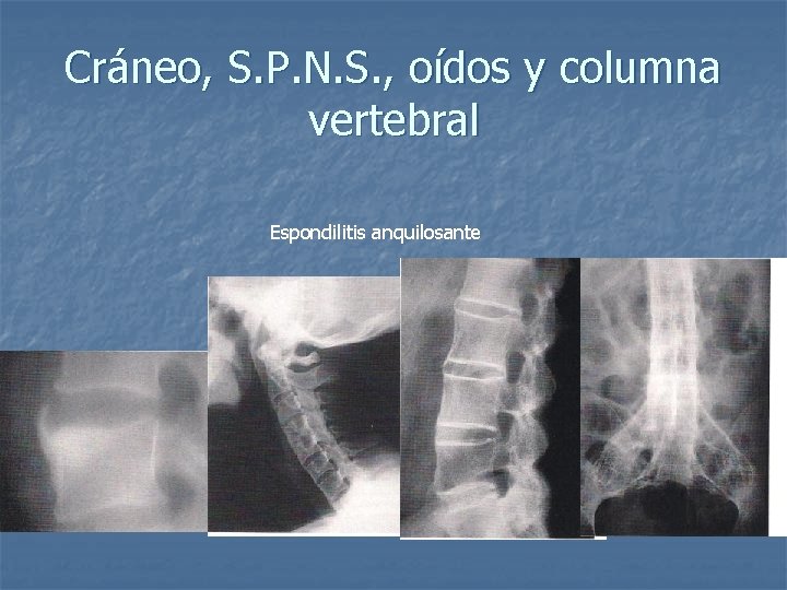 Cráneo, S. P. N. S. , oídos y columna vertebral Espondilitis anquilosante 