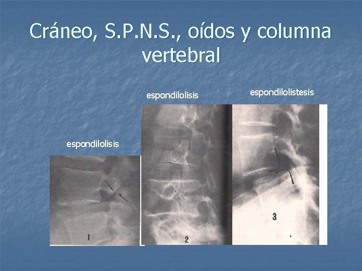 Cráneo, S. P. N. S. , oídos y columna vertebral espondilolisis espondilolistesis 