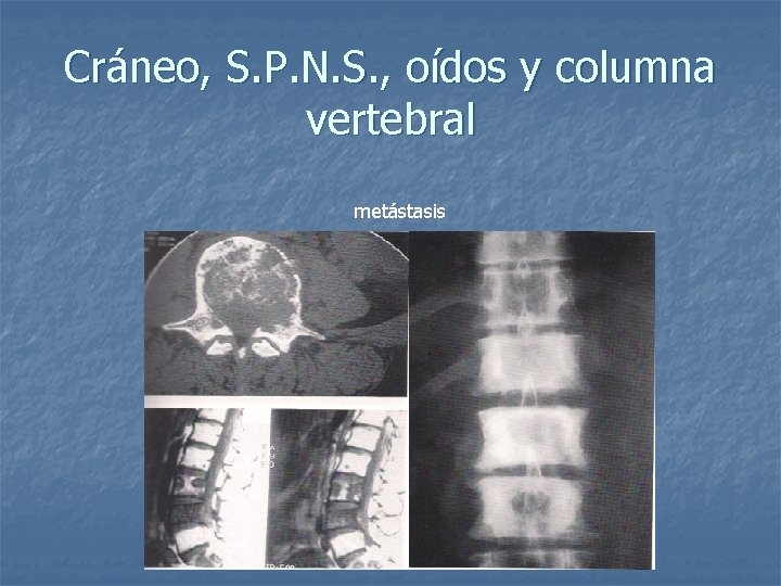Cráneo, S. P. N. S. , oídos y columna vertebral metástasis 