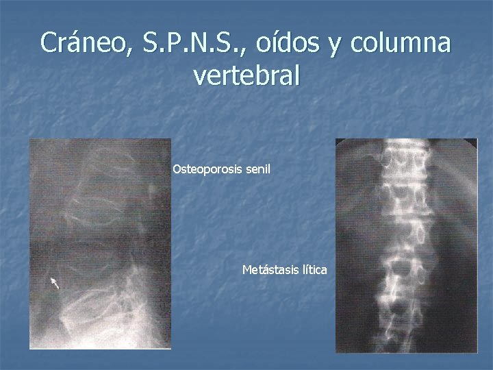 Cráneo, S. P. N. S. , oídos y columna vertebral Osteoporosis senil Metástasis lítica