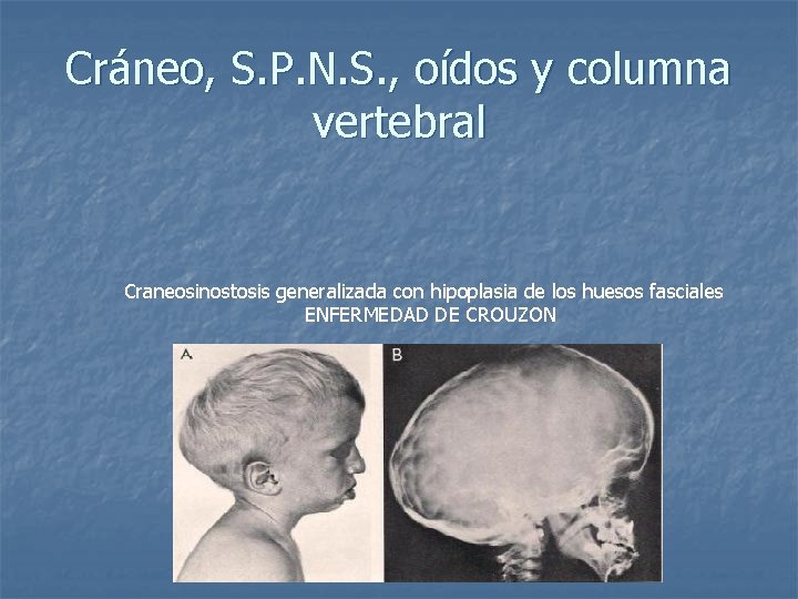 Cráneo, S. P. N. S. , oídos y columna vertebral Craneosinostosis generalizada con hipoplasia