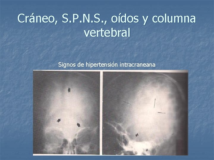 Cráneo, S. P. N. S. , oídos y columna vertebral Signos de hipertensión intracraneana