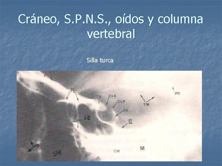 Cráneo, S. P. N. S. , oídos y columna vertebral Silla turca 