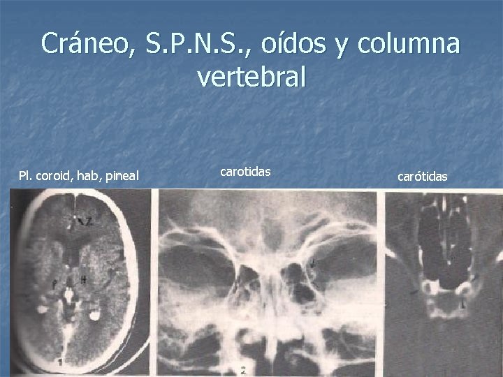 Cráneo, S. P. N. S. , oídos y columna vertebral Pl. coroid, hab, pineal