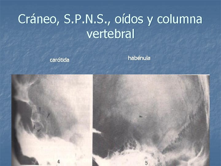 Cráneo, S. P. N. S. , oídos y columna vertebral carótida habénula 