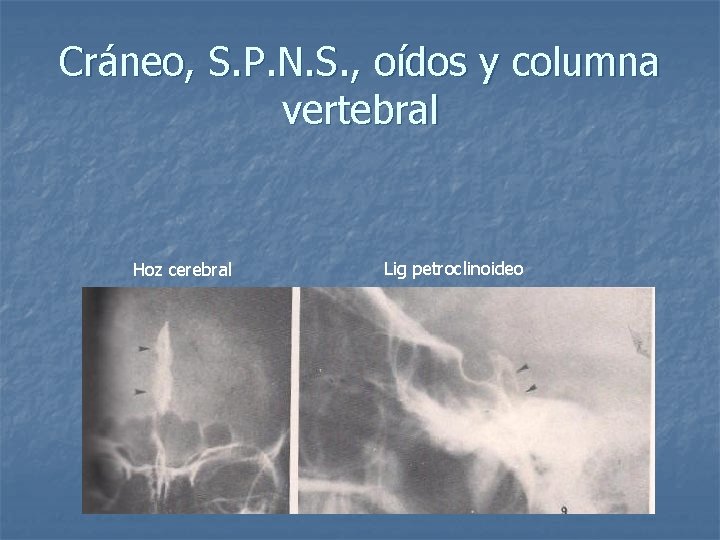 Cráneo, S. P. N. S. , oídos y columna vertebral Hoz cerebral Lig petroclinoideo