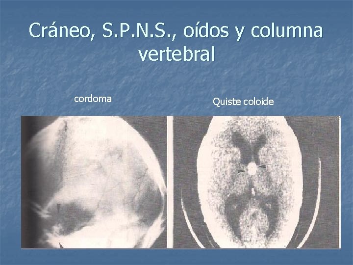 Cráneo, S. P. N. S. , oídos y columna vertebral cordoma Quiste coloide 