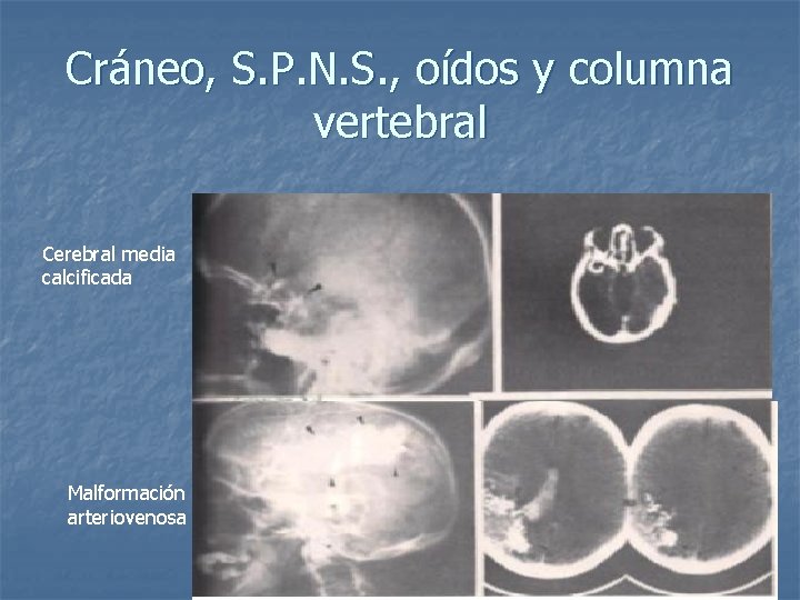 Cráneo, S. P. N. S. , oídos y columna vertebral Cerebral media calcificada Malformación