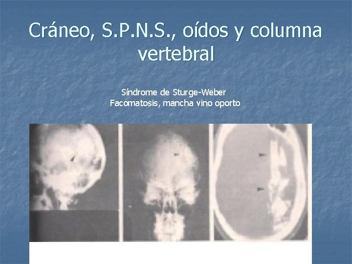 Cráneo, S. P. N. S. , oídos y columna vertebral Síndrome de Sturge-Weber Facomatosis,