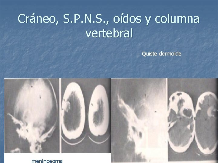 Cráneo, S. P. N. S. , oídos y columna vertebral Quiste dermoide 