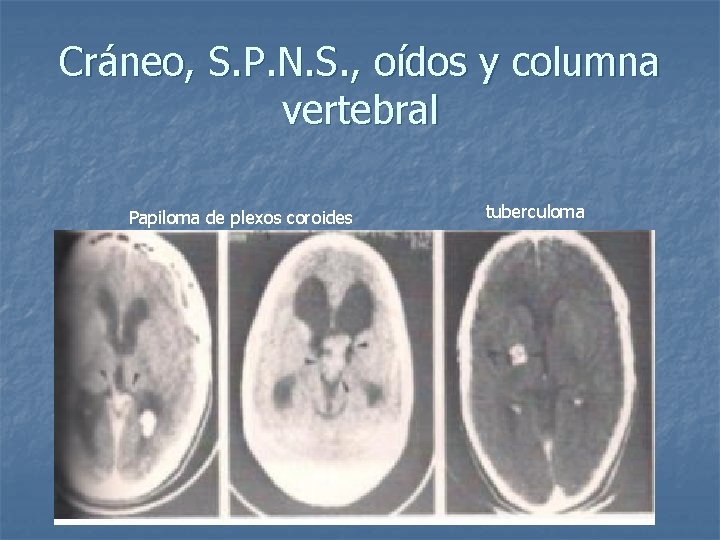 Cráneo, S. P. N. S. , oídos y columna vertebral Papiloma de plexos coroides