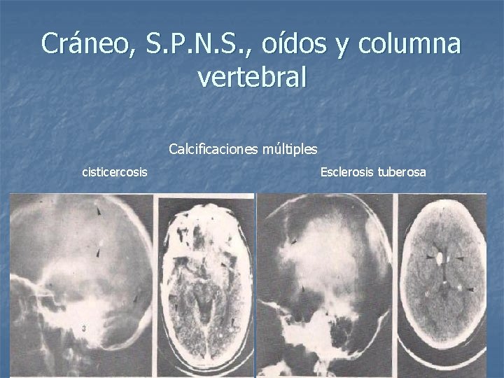 Cráneo, S. P. N. S. , oídos y columna vertebral Calcificaciones múltiples cisticercosis Esclerosis