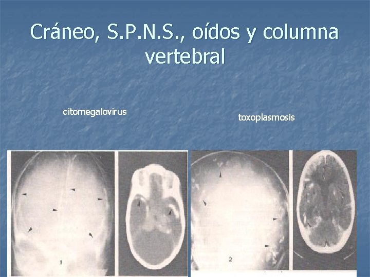 Cráneo, S. P. N. S. , oídos y columna vertebral citomegalovirus toxoplasmosis 