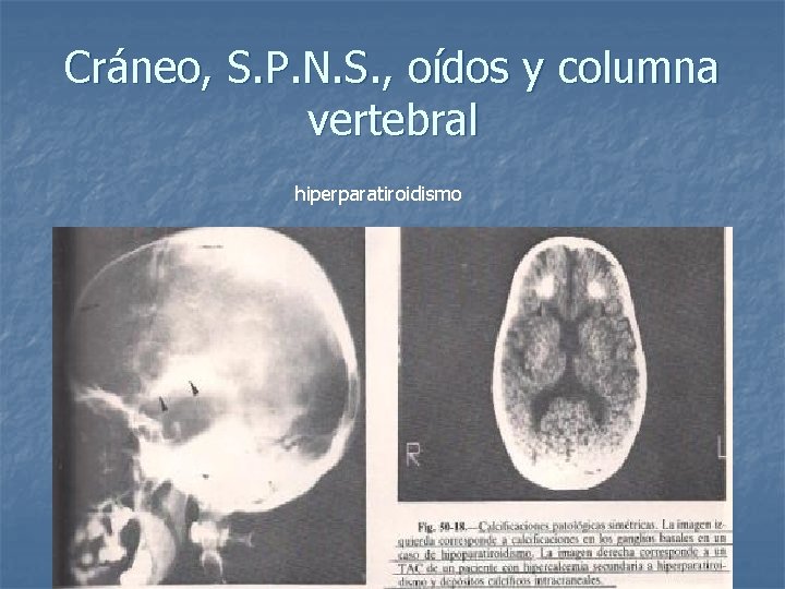 Cráneo, S. P. N. S. , oídos y columna vertebral hiperparatiroidismo 